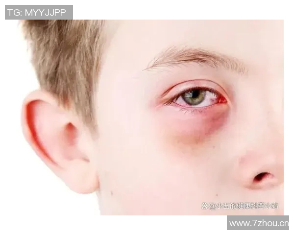 小卡解释鼻子出血原因只是轻微划伤并遭遇眼部意外碰撞